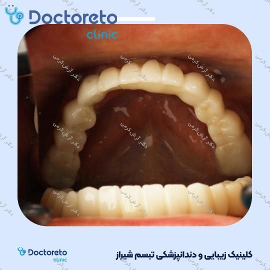 ایمپلنت دیجیتال اشترومن iti سوئیسی با روکش (هر واحد) دکتر آرش کرمی در شیراز 18