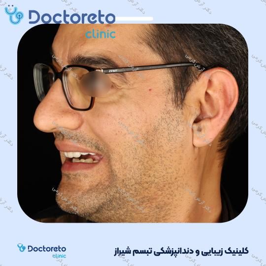 ایمپلنت دیجیتال dio کره ای با روکش (هر واحد) دکتر آرش کرمی در شیراز 101