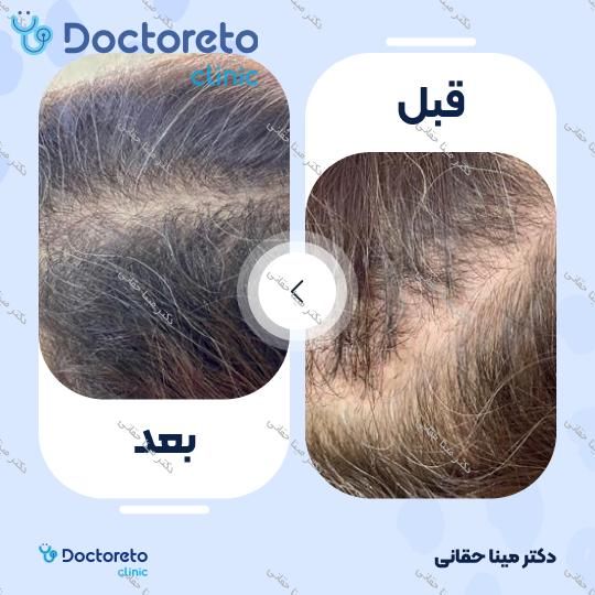 مزوتراپی موی سر با برند مزوتک (1cc)