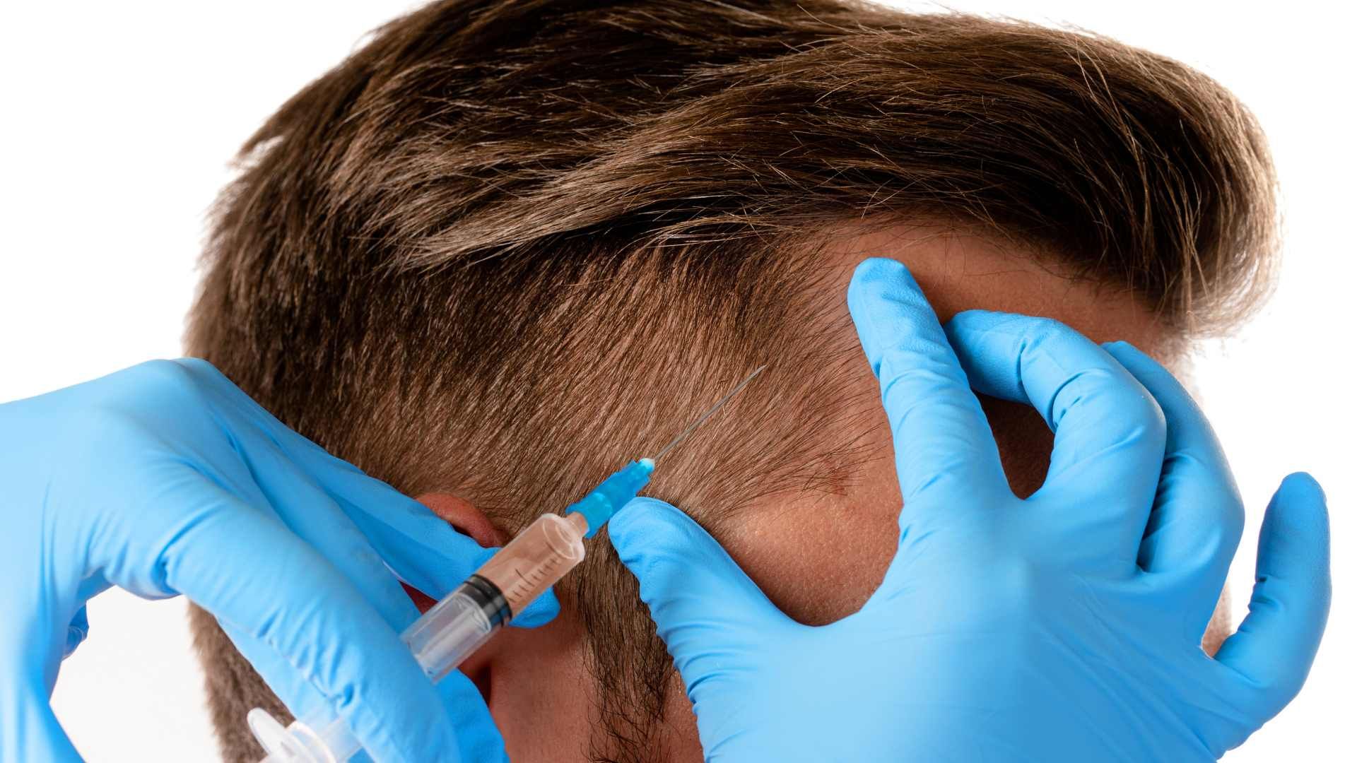 مزوتراپی با کوکتل درمان ریزش موی سر Innoaesthetics HAIR LOSS