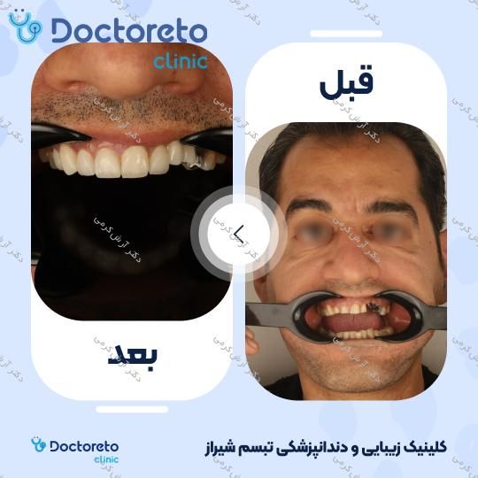 ایمپلنت دیجیتال dio کره ای با روکش (هر واحد) دکتر آرش کرمی در شیراز 102