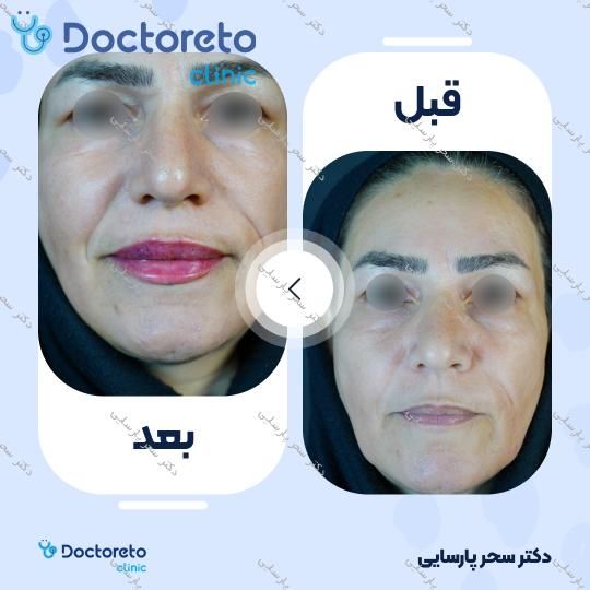 تزریق ژل لب با برند پرفکتا (1CC) دکتر سحر پارسایی در مشهد 5