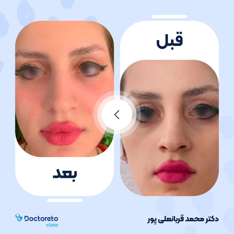 تزریق ژل زیر چشم با برند نورامیس (1cc)