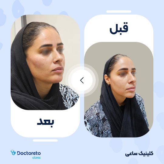 تزریق ژل گونه با برند نورامیس (1cc)