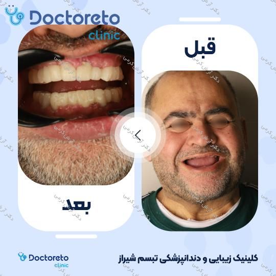 ایمپلنت دیجیتال dio کره ای با روکش (هر واحد) دکتر آرش کرمی در شیراز 128