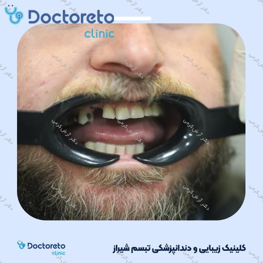 ایمپلنت دیجیتال dio کره ای با روکش (هر واحد) دکتر آرش کرمی در شیراز 53