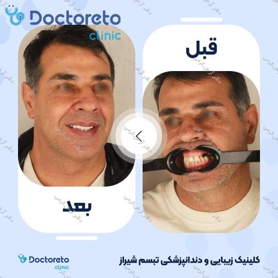 ایمپلنت دیجیتال دنتیس کره ای با روکش (هر واحد) دکتر آرش کرمی در شیراز 14