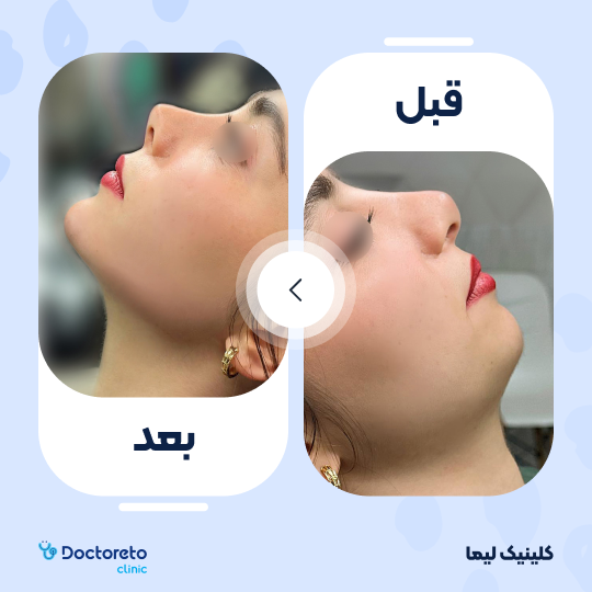 تزریق ژل چانه با برند نورامیس (1cc)