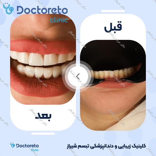 ونیر کامپوزیت توکویاما ژاپنی (هر واحد) دکتر مریم زراعتکار در شیراز 13