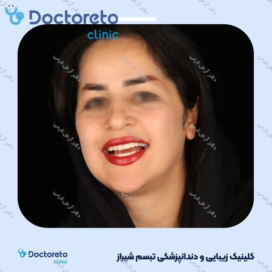 ایمپلنت دیجیتال دنتیس کره ای با روکش (هر واحد) دکتر آرش کرمی در شیراز 80