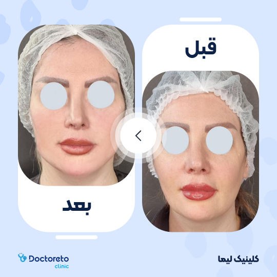 تزریق ژل خط خنده با برند آلاینا (1cc)