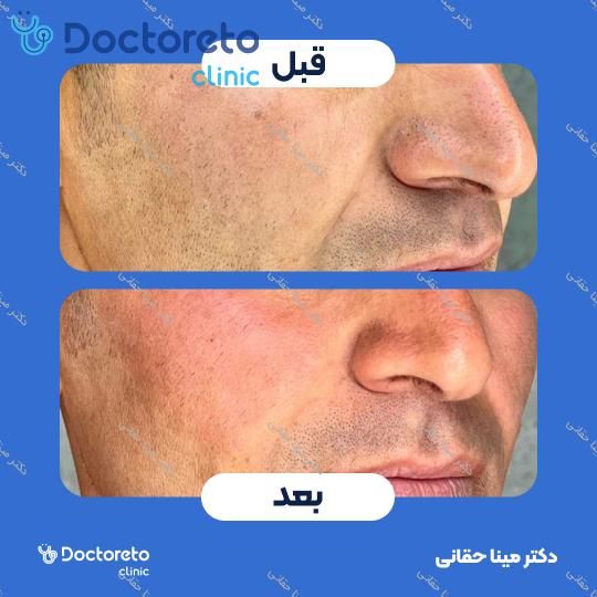 تزریق ژل گونه با برند بلوترو (1CC) دکتر مینا حقانی در اصفهان 2