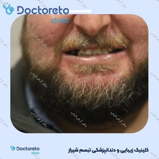 ایمپلنت دیجیتال دنتیس کره ای بدون روکش (هر واحد) دکتر آرش کرمی در شیراز 58