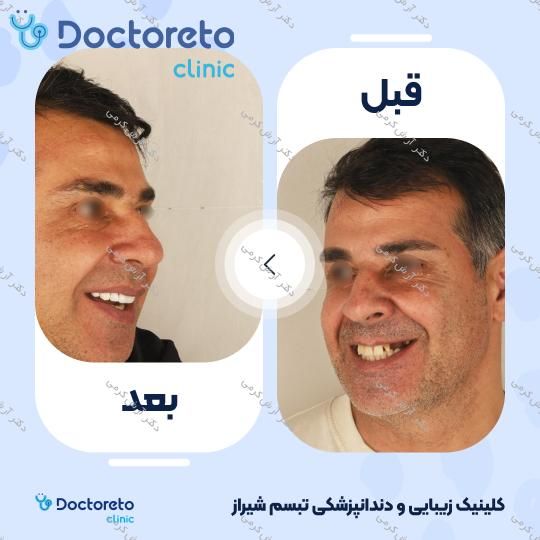 ایمپلنت دیجیتال دنتیس کره ای با روکش (هر واحد) دکتر آرش کرمی در شیراز 19