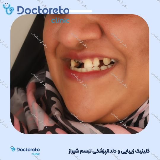 ایمپلنت دیجیتال dio کره ای با روکش (هر واحد) دکتر آرش کرمی در شیراز 33