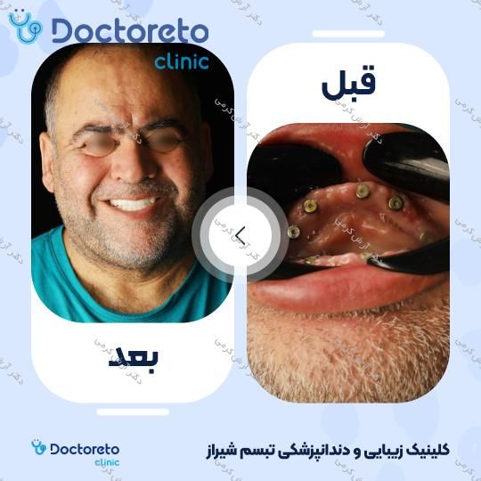 ایمپلنت دیجیتال dio کره ای با روکش (هر واحد) دکتر آرش کرمی در شیراز 125