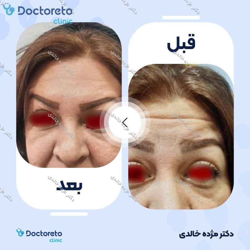 تزریق بوتاکس صورت (پیشانی، خط اخم، پنجه کلاغی) با برند دیستون