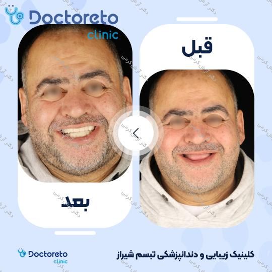 ایمپلنت دیجیتال dio کره ای با روکش (هر واحد) دکتر آرش کرمی در شیراز 133