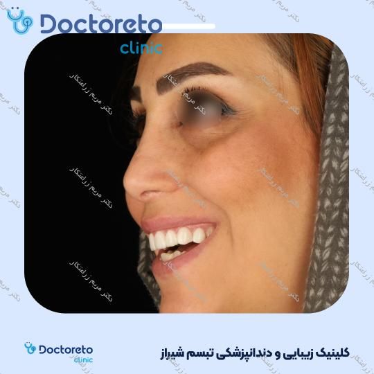 ونیر کامپوزیت توکویاما ژاپنی (هر واحد) دکتر مریم زراعتکار در شیراز 22