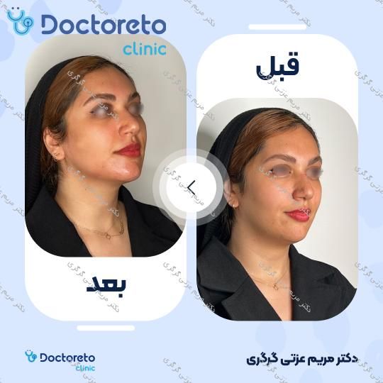 تزریق ژل زاویه فک با برند اینووسنس (1CC) دکتر مریم عزتی گرگری در تهران 2