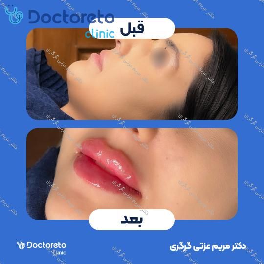 تزریق ژل لب با برند اینووسنس (1CC) دکتر مریم عزتی گرگری در تهران 3