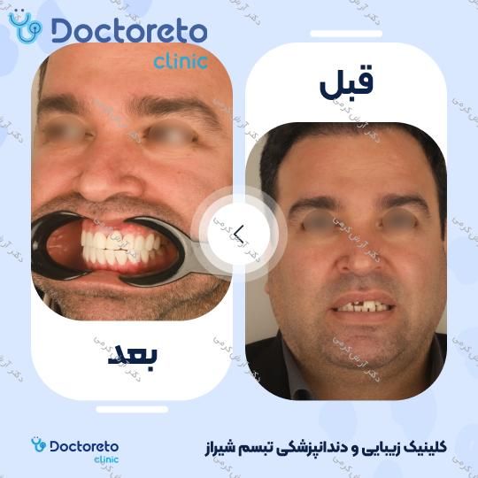 ایمپلنت دیجیتال dio کره ای با روکش (هر واحد) دکتر آرش کرمی در شیراز 23