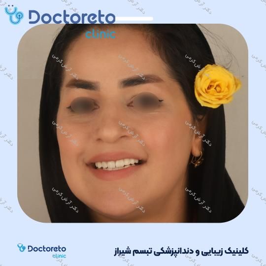 ایمپلنت دیجیتال دنتیس کره ای با روکش (هر واحد) دکتر آرش کرمی در شیراز 93