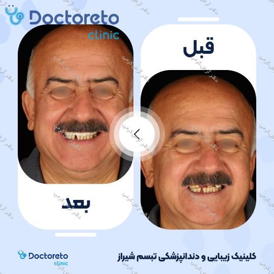 ایمپلنت دیجیتال dio کره ای با روکش (هر واحد) دکتر آرش کرمی در شیراز 47