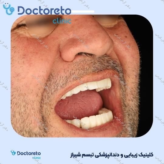 ایمپلنت دیجیتال dio کره ای با روکش (هر واحد) دکتر آرش کرمی در شیراز 120