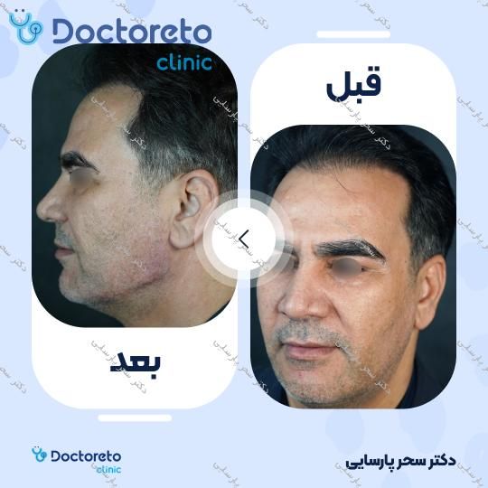 تزریق ژل چانه با برند الانسه (1CC) دکتر سحر پارسایی در مشهد 11