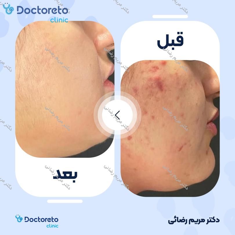 رفع جای جوش ، زخم و اسکار با دستگاه rf فرکشنال (هر جلسه)