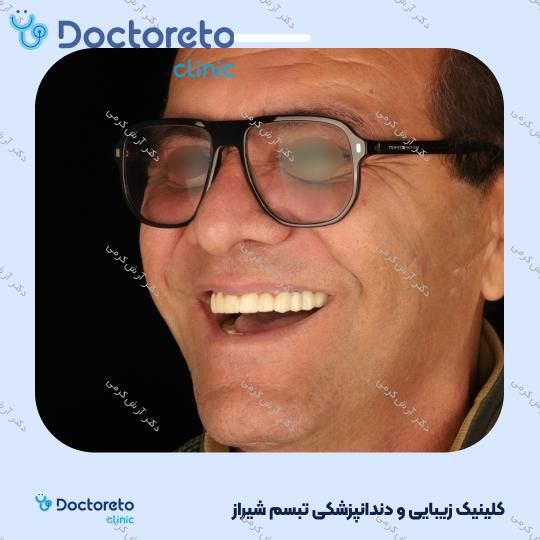 ایمپلنت دیجیتال dio کره ای با روکش (هر واحد) دکتر آرش کرمی در شیراز 60