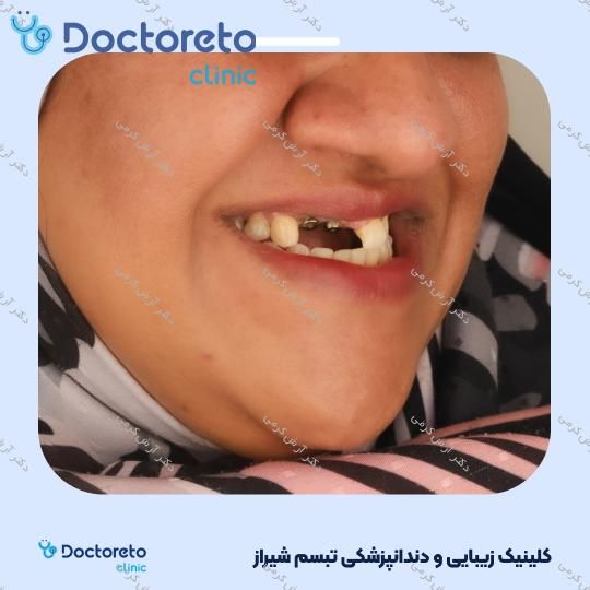 ایمپلنت دیجیتال دنتیس کره ای بدون روکش (هر واحد) دکتر آرش کرمی در شیراز 37