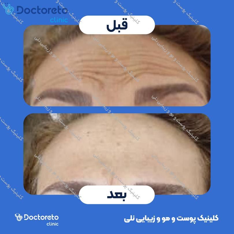 تزریق بوتاکس صورت (پیشانی، خط اخم، پنجه کلاغی) با برند دیستون کلینیک پوست و مو و زیبایی نلی در شیراز 3