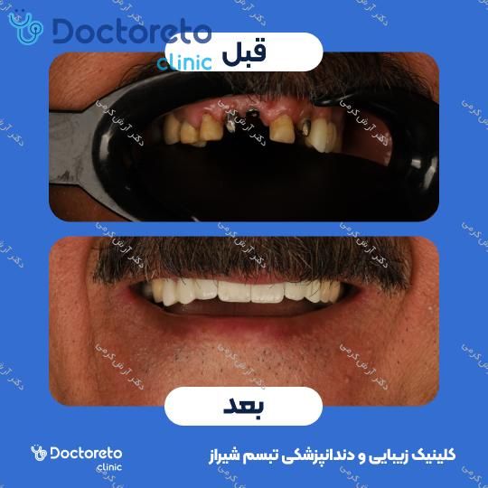 ایمپلنت دیجیتال دنتیس کره ای بدون روکش (هر واحد) دکتر آرش کرمی در شیراز 44