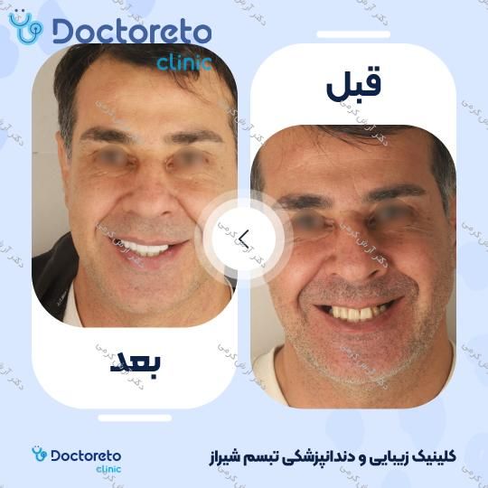 ایمپلنت دیجیتال dio کره ای با روکش (هر واحد) دکتر آرش کرمی در شیراز 22