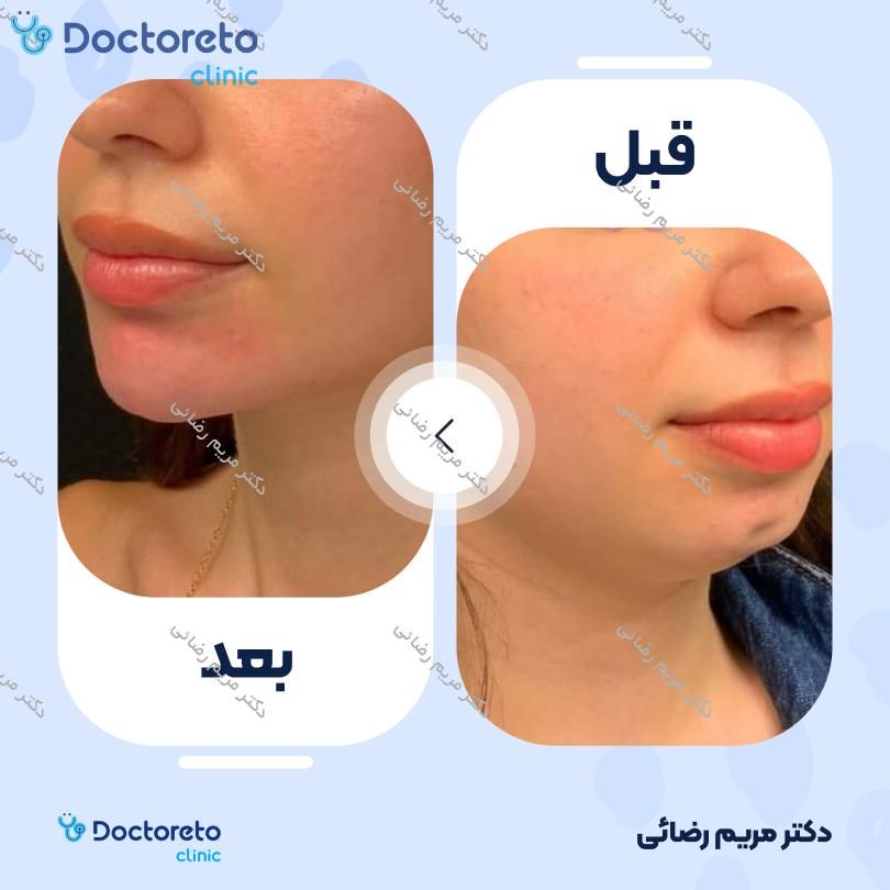 تزریق ژل چانه با برند رمدیوم (1cc)