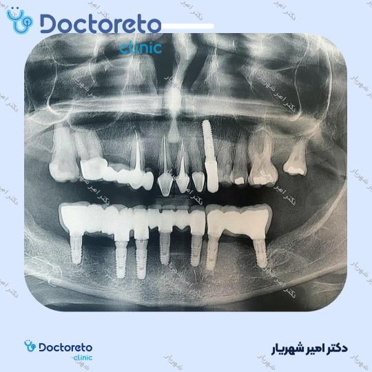 ایمپلنت نئودنت برزیلی با روکش (هر واحد) دکتر امیر شهریار در تهران 5
