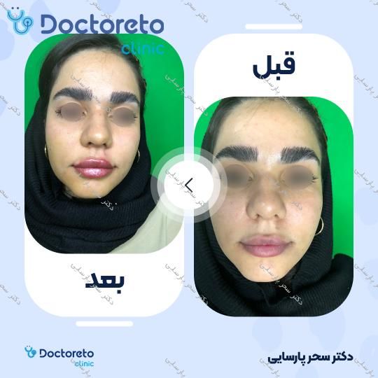 تزریق ژل لب با برند روولاکس (1CC) دکتر سحر پارسایی در مشهد 10