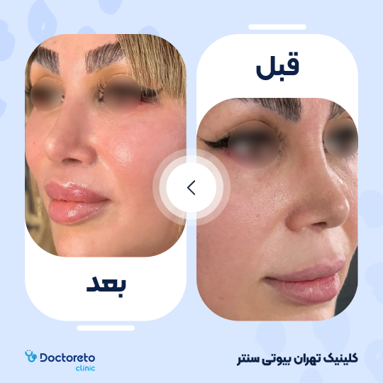 تزریق ژل گونه با برند نورامیس (1cc)