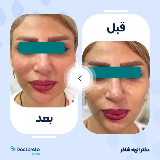 تزریق ژل گونه با برند استایلج (1CC)