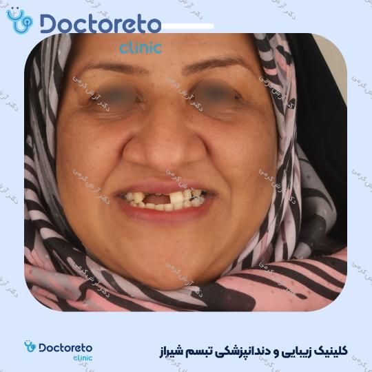 ایمپلنت دیجیتال dio کره ای با روکش (هر واحد) دکتر آرش کرمی در شیراز 40