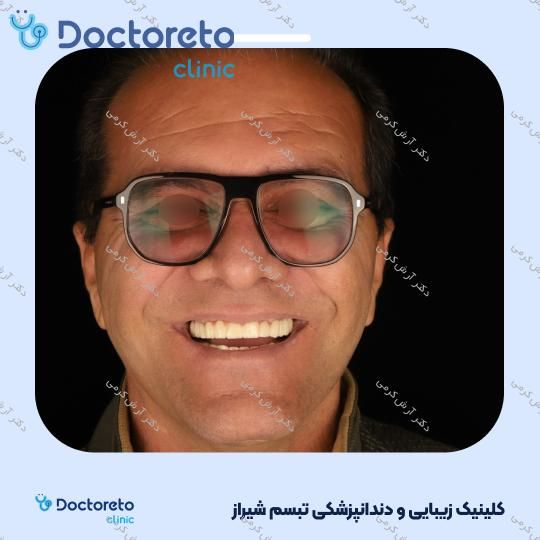 ایمپلنت دیجیتال dio کره ای با روکش (هر واحد) دکتر آرش کرمی در شیراز 65