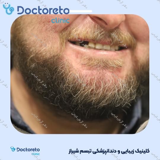 ایمپلنت دیجیتال dio کره ای با روکش (هر واحد) دکتر آرش کرمی در شیراز 57