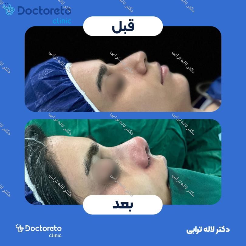 عمل جراحی مجدد زیبایی بینی (رینوپلاستی) دکتر لاله ترابی در رشت 6