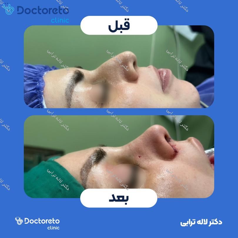 عمل جراحی مجدد زیبایی بینی (رینوپلاستی) دکتر لاله ترابی در رشت 2