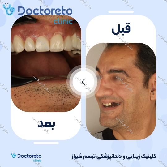 ایمپلنت دیجیتال دنتیس کره ای با روکش (هر واحد) دکتر آرش کرمی در شیراز 108