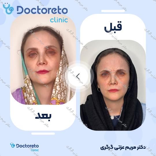 تزریق بوتاکس صورت (پیشانی، دور چشم و پل بینی) با برند مصپورت دکتر مریم عزتی گرگری در تهران 2