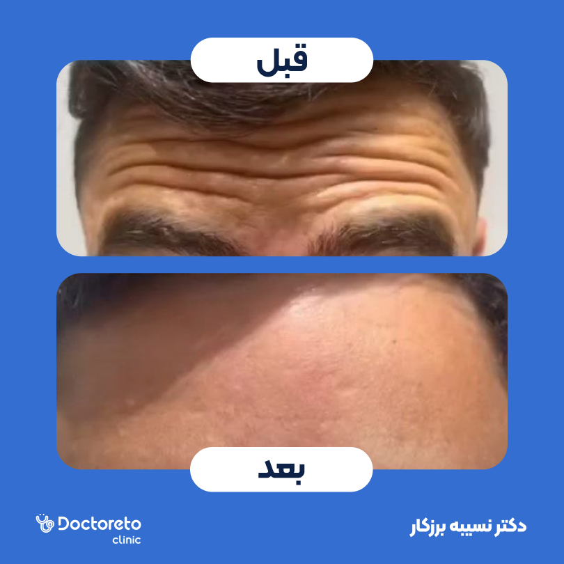 تزریق بوتاکس صورت (پیشانی، خط اخم، دور چشم) با برند مصپورت دکتر نسیبه برزکار در تهران 3