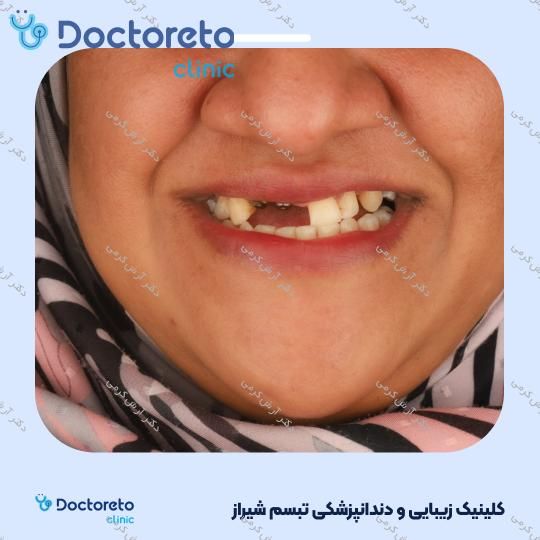 ایمپلنت دیجیتال dio کره ای با روکش (هر واحد) دکتر آرش کرمی در شیراز 34